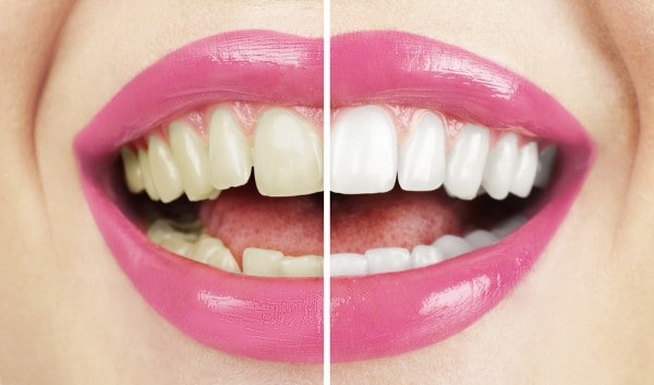 What Makes Ultima White Teeth Whitening Different Redditch