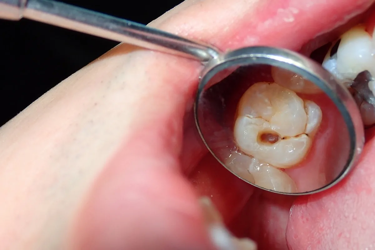 Why Do Teeth Crack? Common Causes to Know Redditch