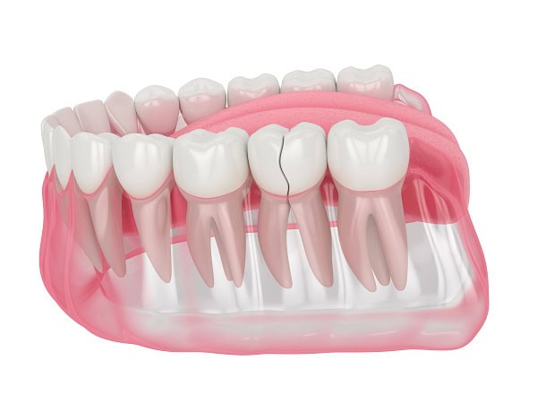How Can You Manage Pain and Discomfort After a Root Canal Redditch?
