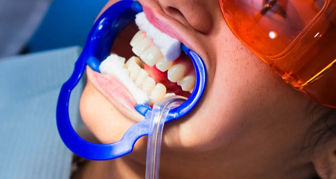How Teeth Whitening Treatments Actually Work on Your Enamel Redditch
