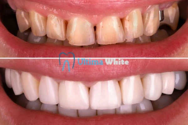 What Makes Instant Teeth Whitening Treatments So Popular Redditch?
